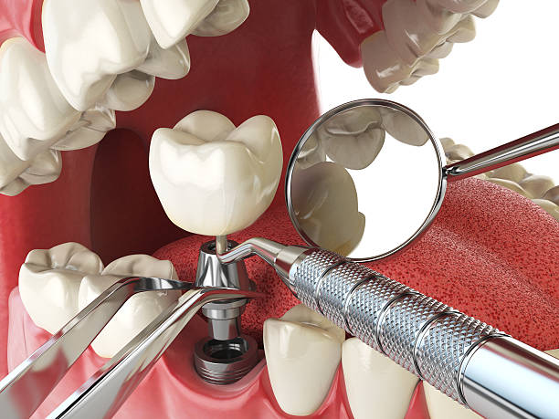 Best Emergency Wisdom Teeth Removal in Postville, IA